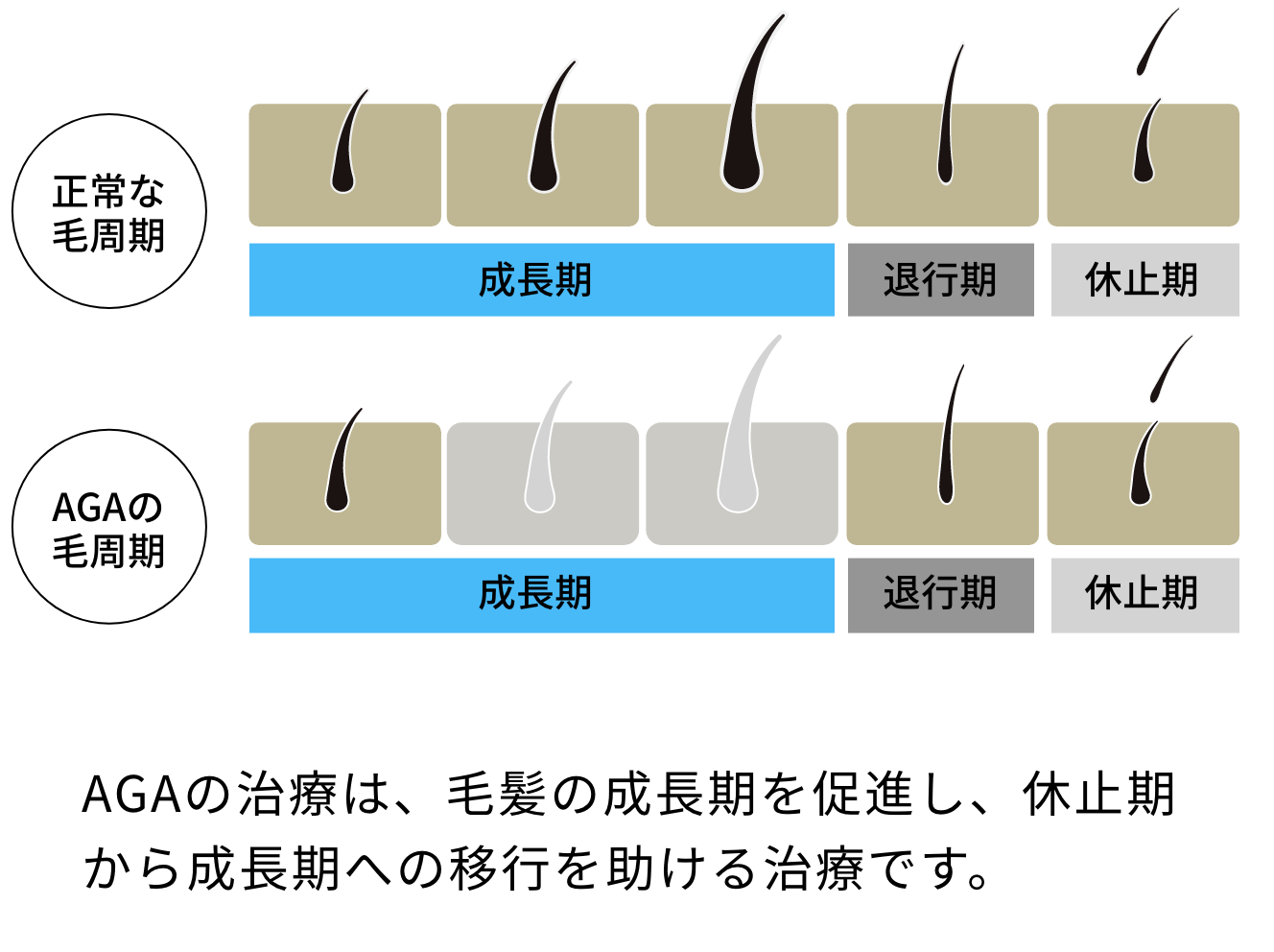 AGAの治療は、毛髪の成長期を促進し、休止期から成長期への移行を助ける治療です。